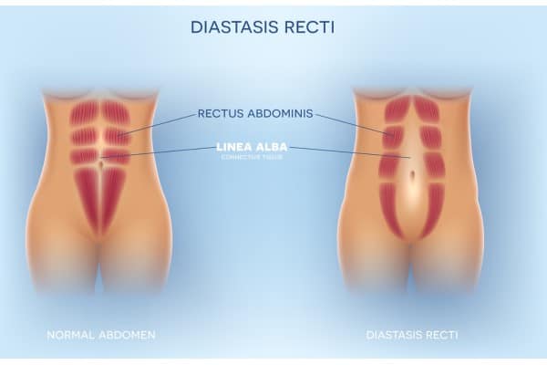 What Non-Surgical Options Are Available for Diastasis Recti Brockenhurst?