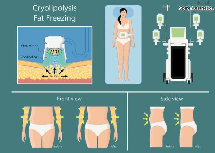 Image of diet and fat freezing combined for best results for Spire Aesthetics Brockenhurst