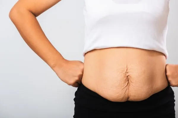 Image of a woman's stomach after weight loss with sagging skin following a gastric band Brockenhurst