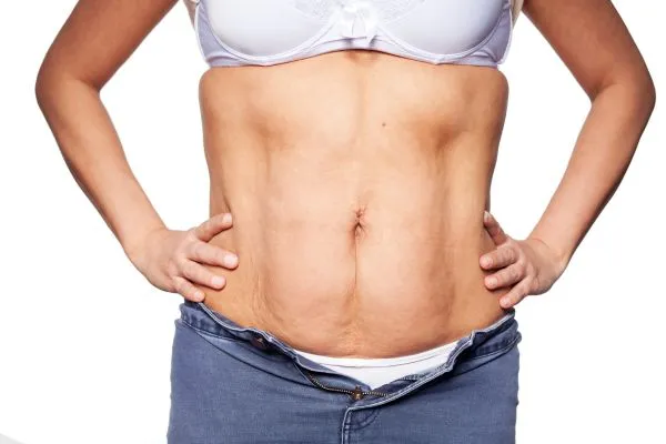 sagging skin on woman's stomach after weight loss injections Brockenhurst
