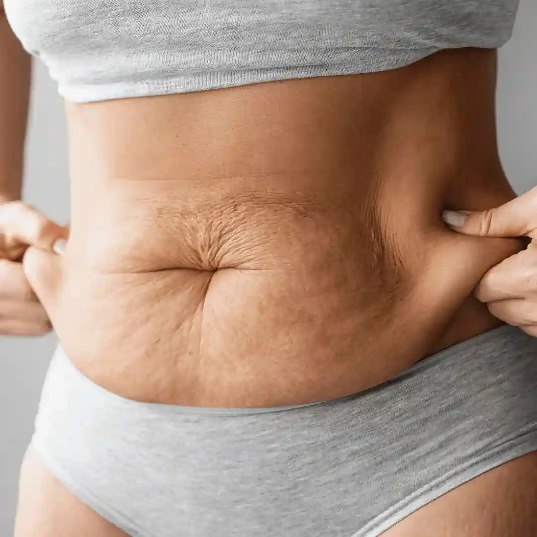 Is It Normal to Have Loose Skin After Pregnancy Brockenhurst?