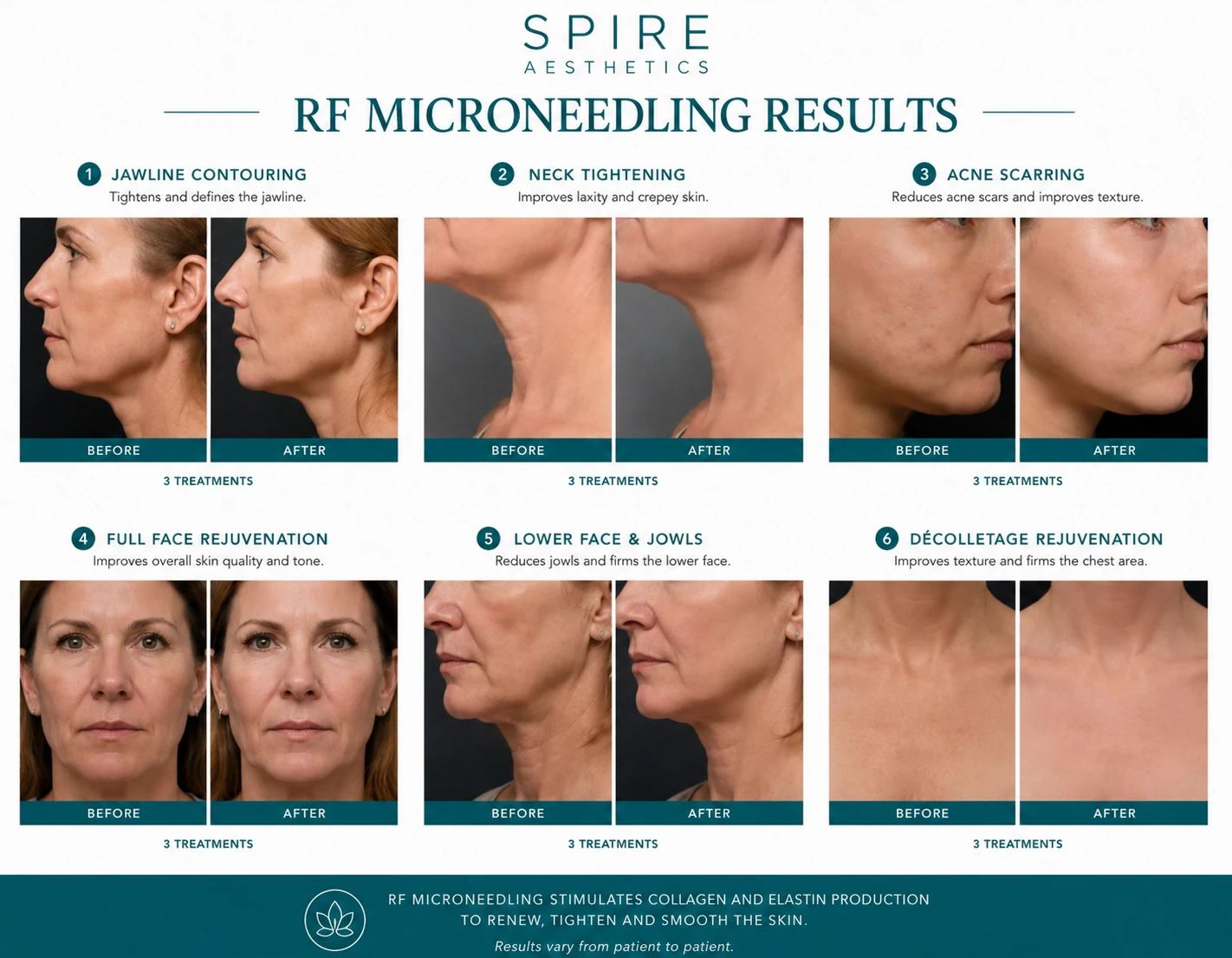 RF Microneedling Skin tightening Brockenhurst results