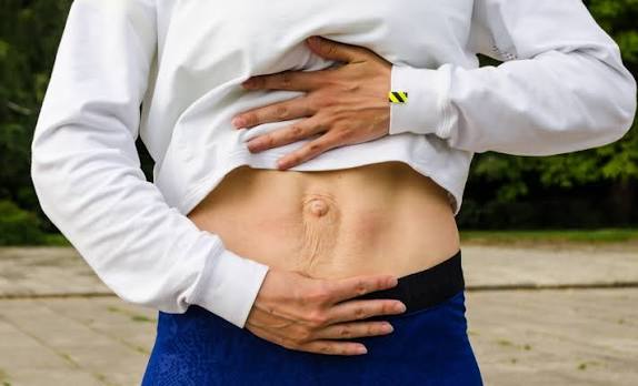 When Could Diastasis Recti Be the Missing Piece of the Puzzle Brockenhurst?