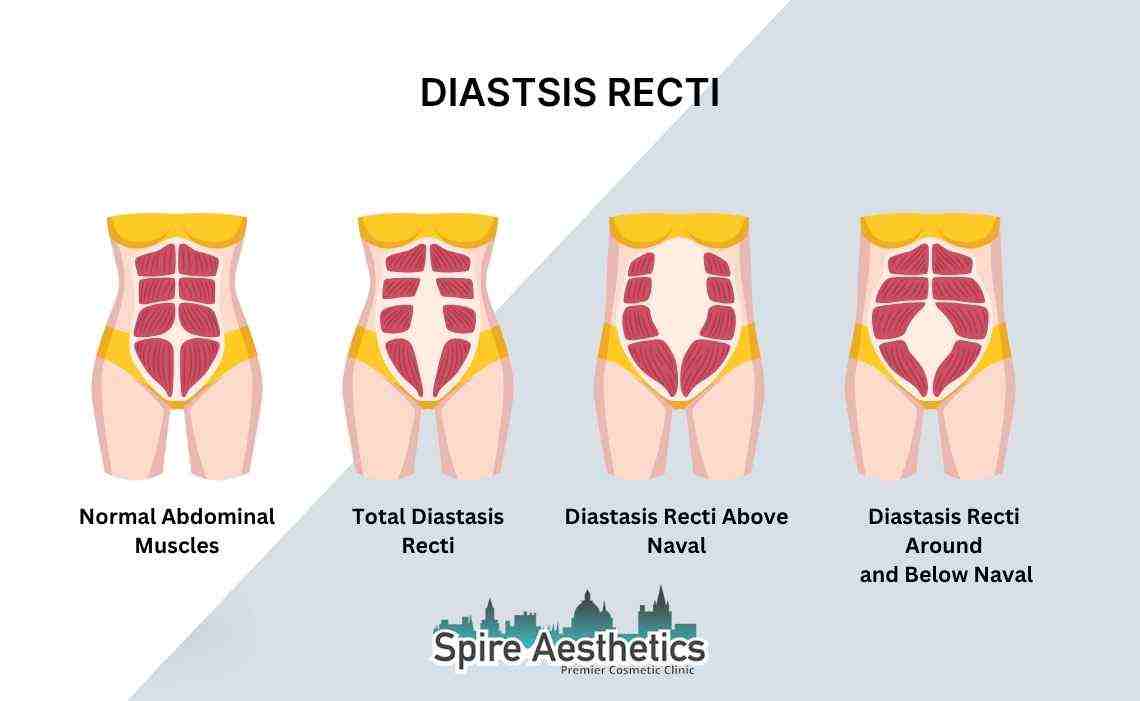Is Non-Surgical Diastasis Recti Treatment Right for You? Common Concerns Answered Brockenhurst